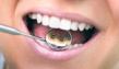 Отбеливание зубов